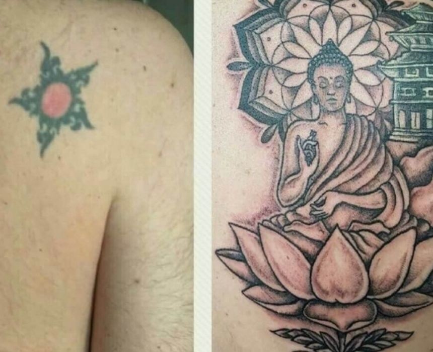 eliminar tatuajes en Lugo