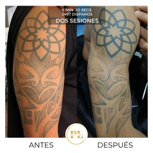 Borrado y eliminación de tatuajes 0