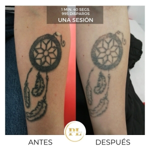 Borrado y eliminación de tatuajes 4