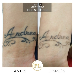 Borrado y eliminación de tatuajes 3