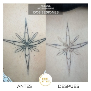 Borrado y eliminación de tatuajes 2