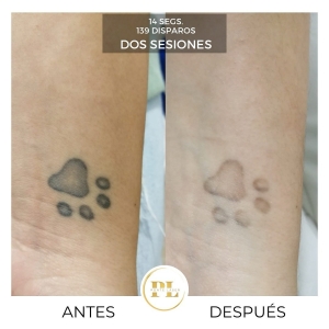 Borrado y eliminación de tatuajes 1