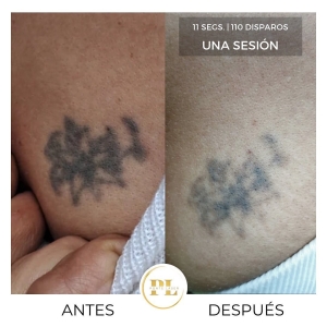 Borrado y eliminación de tatuajes 8