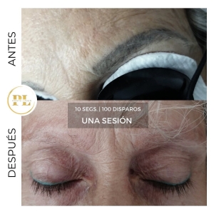 Borrado y eliminación de tatuajes 7