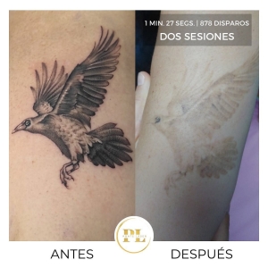 Borrado y eliminación de tatuajes 6