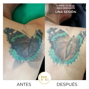 Borrado y eliminación de tatuajes 5